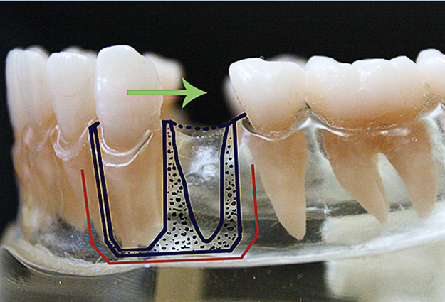 De versnelde orthodontische behandeling