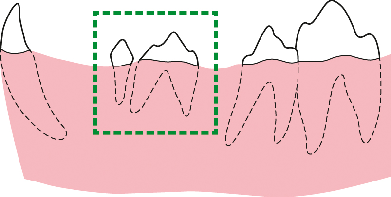 De versnelde orthodontische behandeling