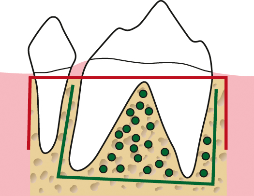 De versnelde orthodontische behandeling