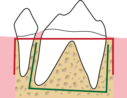 De versnelde orthodontische behandeling