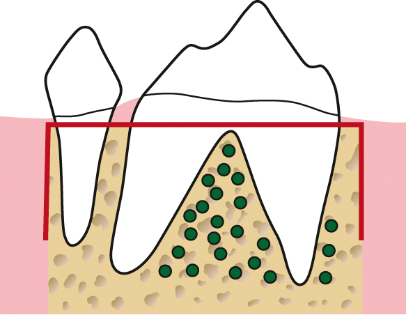 De versnelde orthodontische behandeling