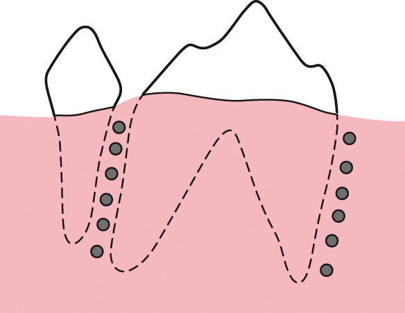 De versnelde orthodontische behandeling