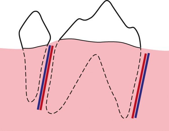 De versnelde orthodontische behandeling