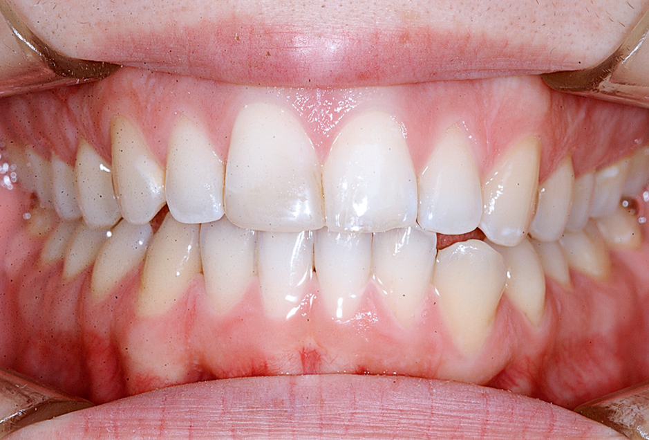 Gingivarecessies en orthodontie