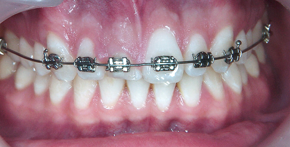 Orthodontische extrusie voorafgaand aan implantologie in de esthetische zone