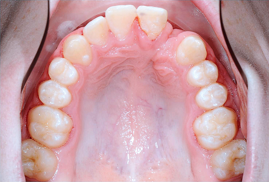 De gecombineerde orthodontisch restauratieve behandeling