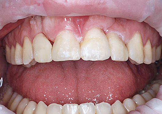 De gecombineerde orthodontisch restauratieve behandeling