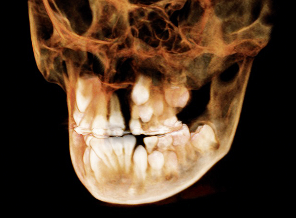 Interdisciplinaire orthodontisch-chirurgische behandeling van schisis van 9 tot 20 jaar