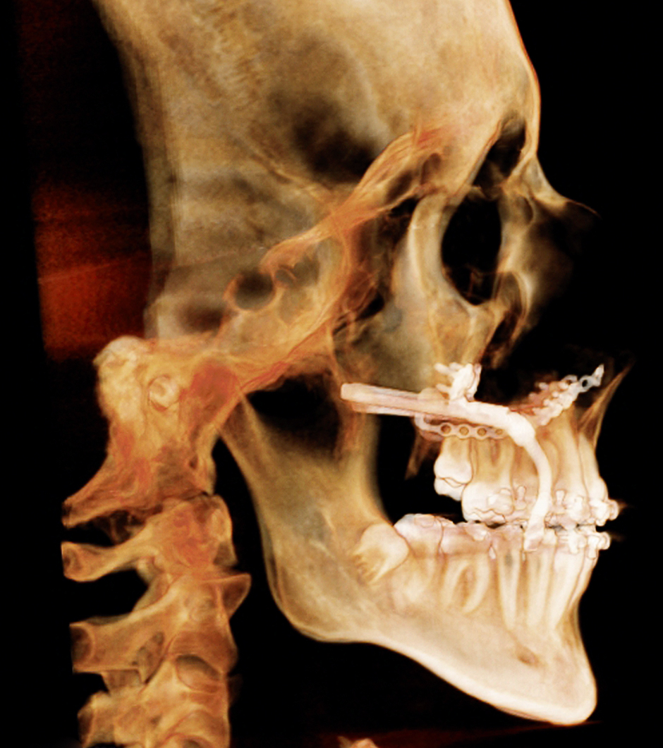 Interdisciplinaire orthodontisch-chirurgische behandeling van schisis van 9 tot 20 jaar