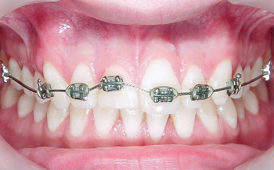 Orthodontische extrusie voorafgaand aan implantologie in de esthetische zone
