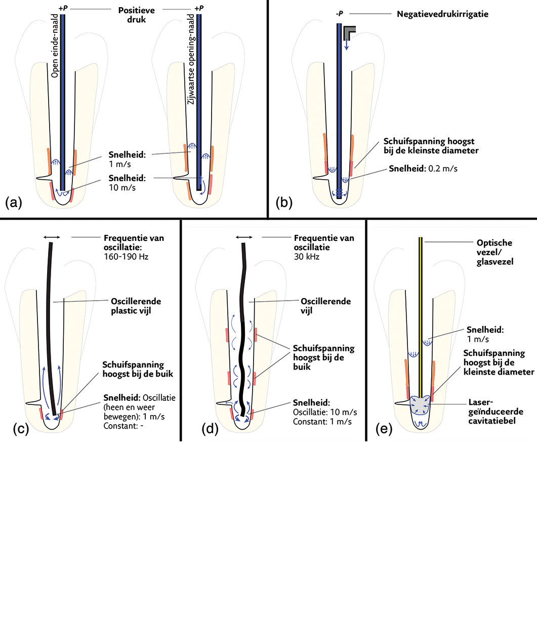 Endodontologie in beweging: nieuwe concepten, materialen en technieken 3. De rol van activatie van wortelkanaal-spoelmiddelen tijdens de wortelkanaalbehandeling