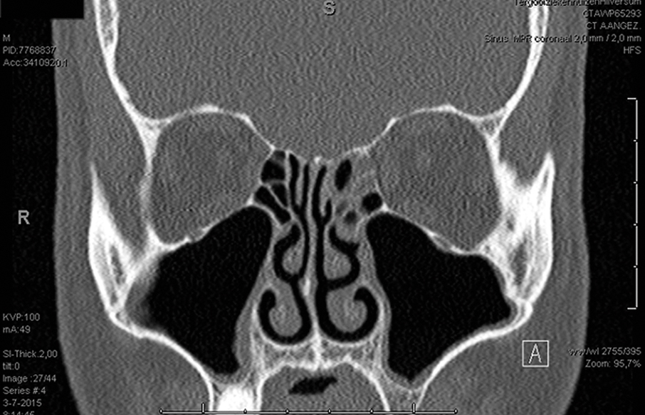 lichte sluiering ethmoid