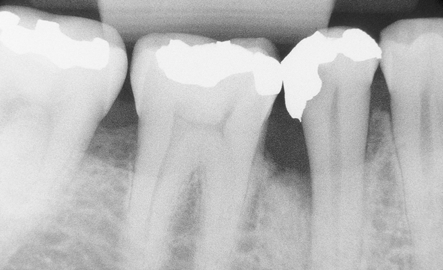 herstel parodontaal defect na AB-behandeling