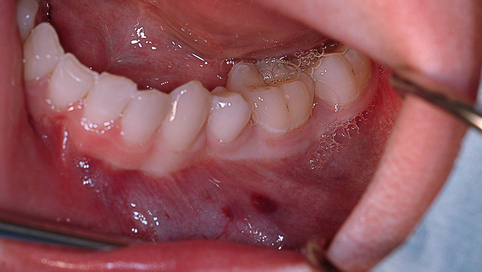 Pijnloze zwelling in premolaar/molaarstreek mandibula links