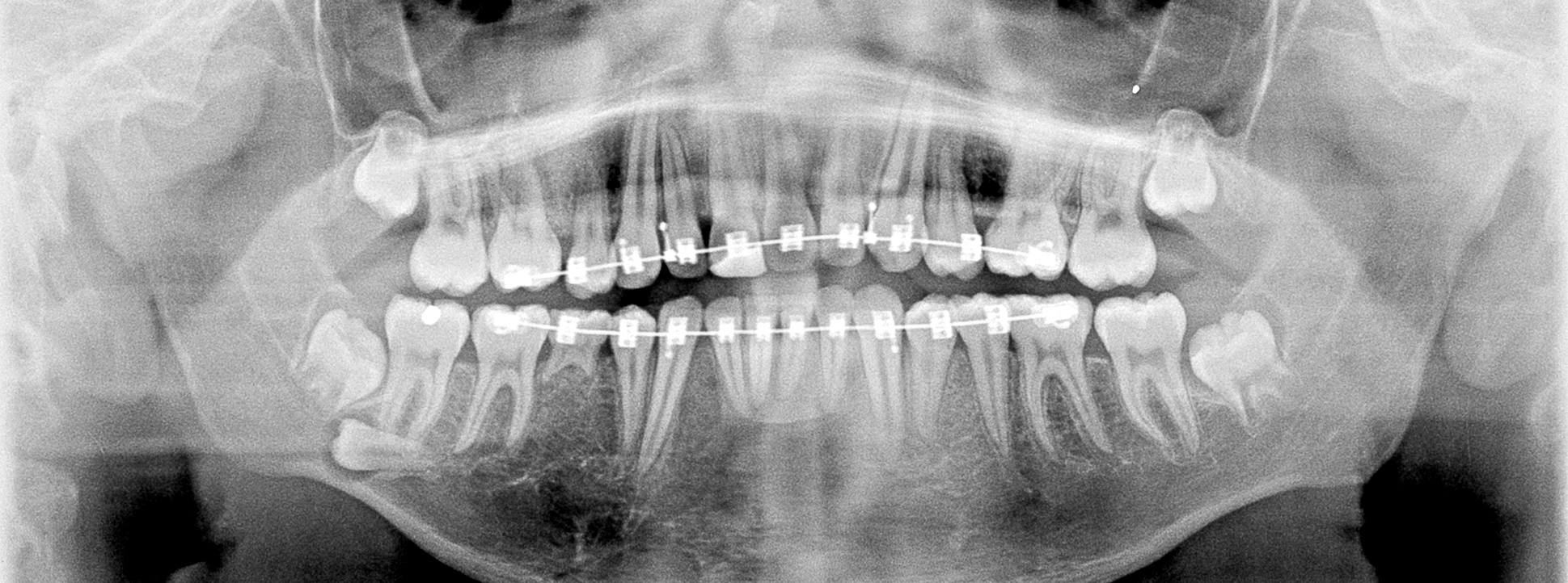 Gebitselement langs rand mandibula