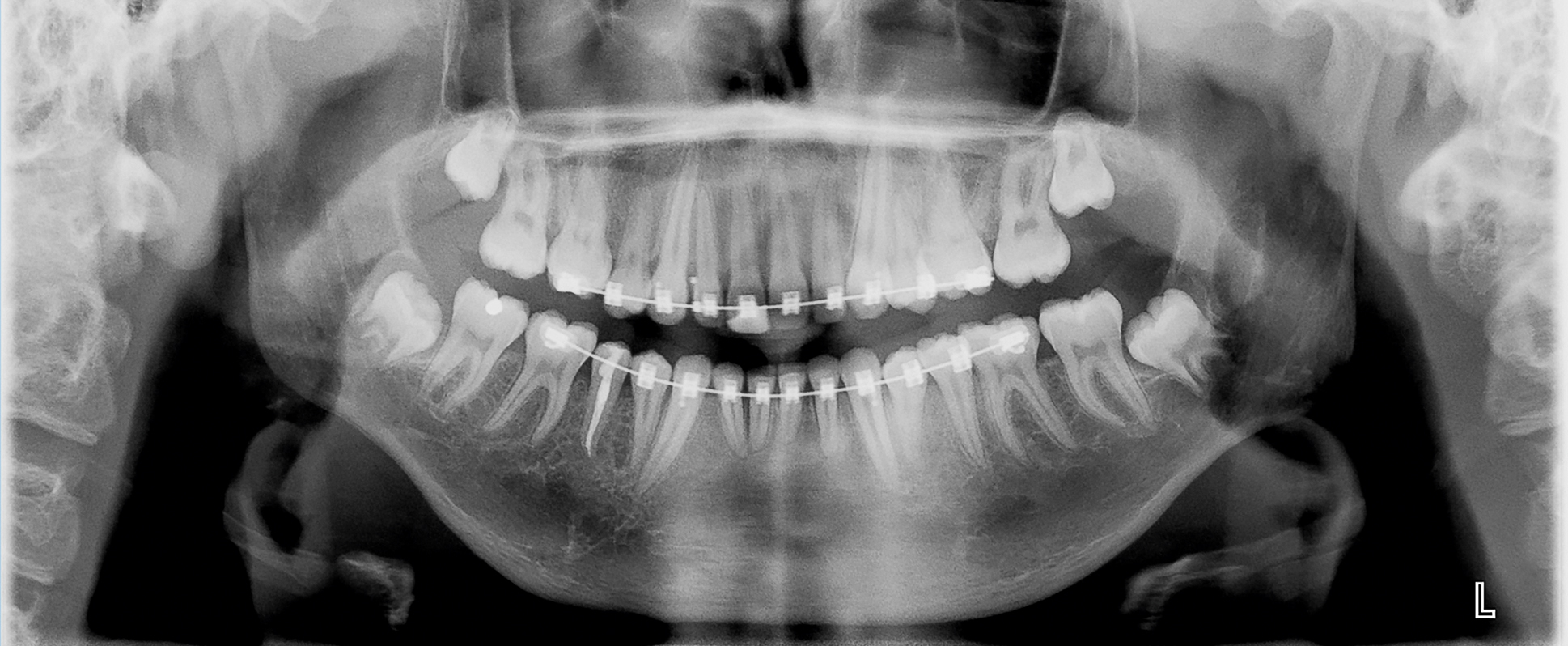 Getransplanteerd gebitselement gefixeerd aan orthodontische draad