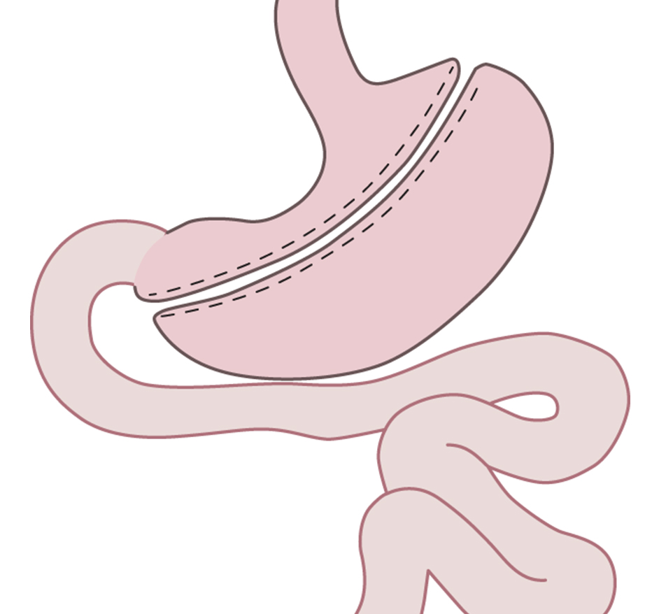 Gastric sleeve