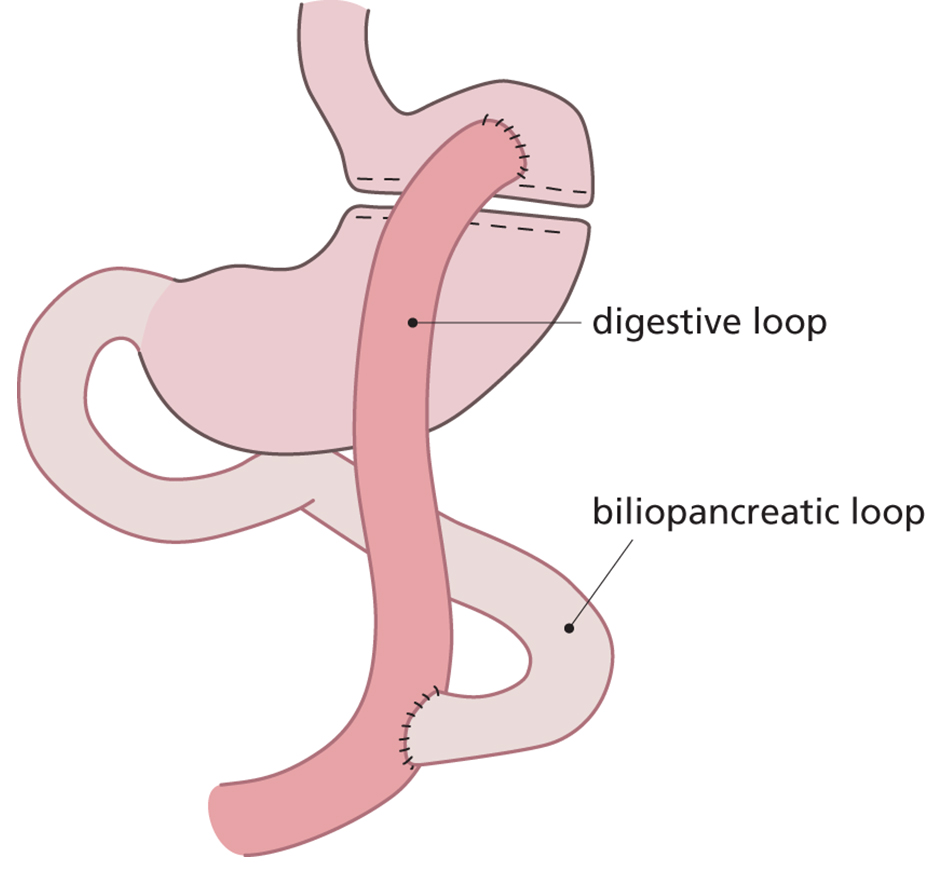 Gastric bypass