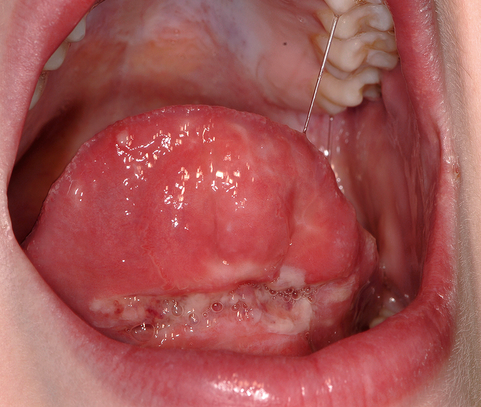 Orale automutilatie: een repetitief tongtrauma