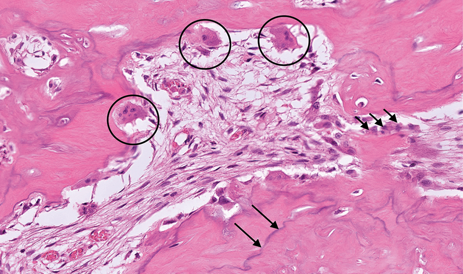 Histologie cementoblastoom