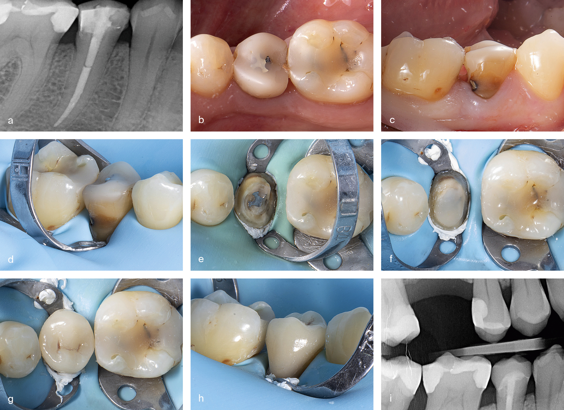 Endodontisch behandeld gebitselement 