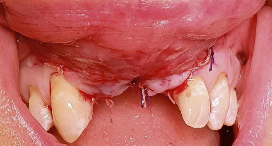 Sluiten van de wond in de maxilla