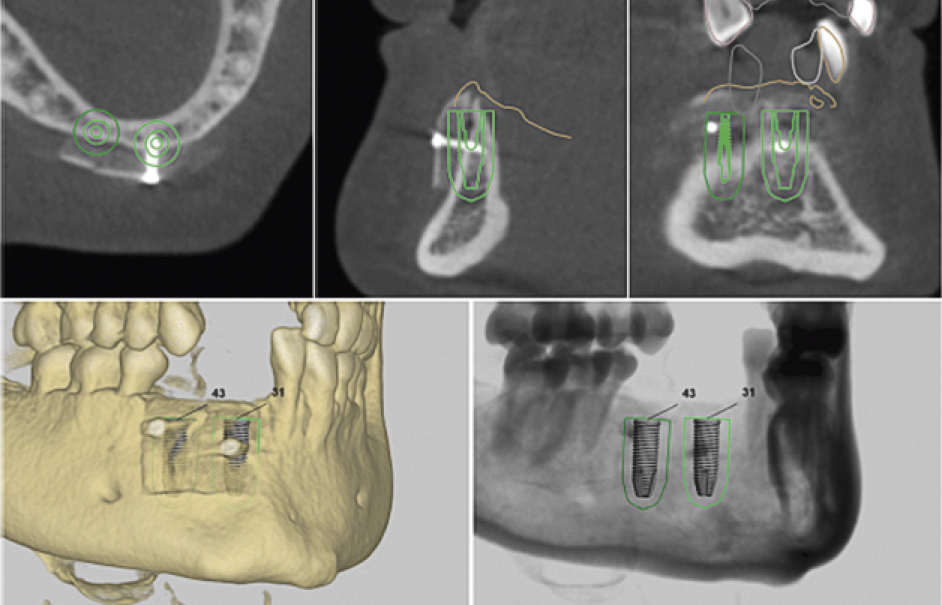 3D-planning mandibula