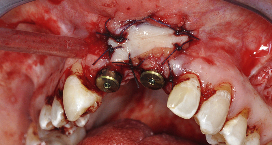 Status na plaatsen implantaten