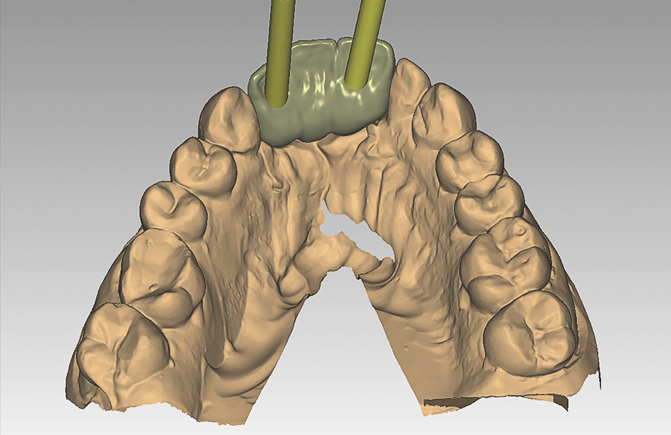 Digitaal design brug in maxilla