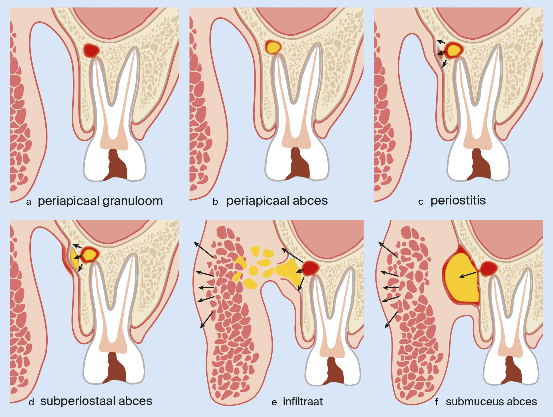 Verschillende fases van dentogene ontsteking