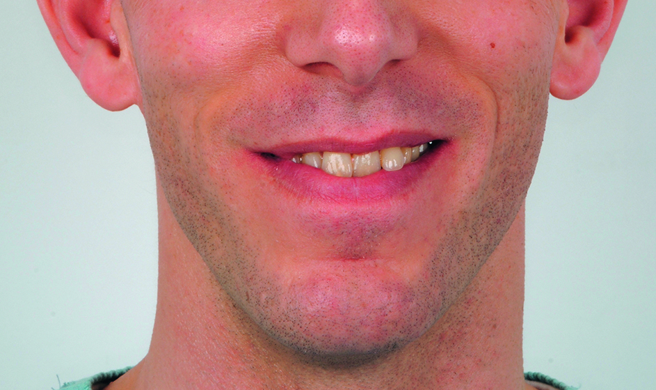 Extraorale opname vóór orthodontische behandeling