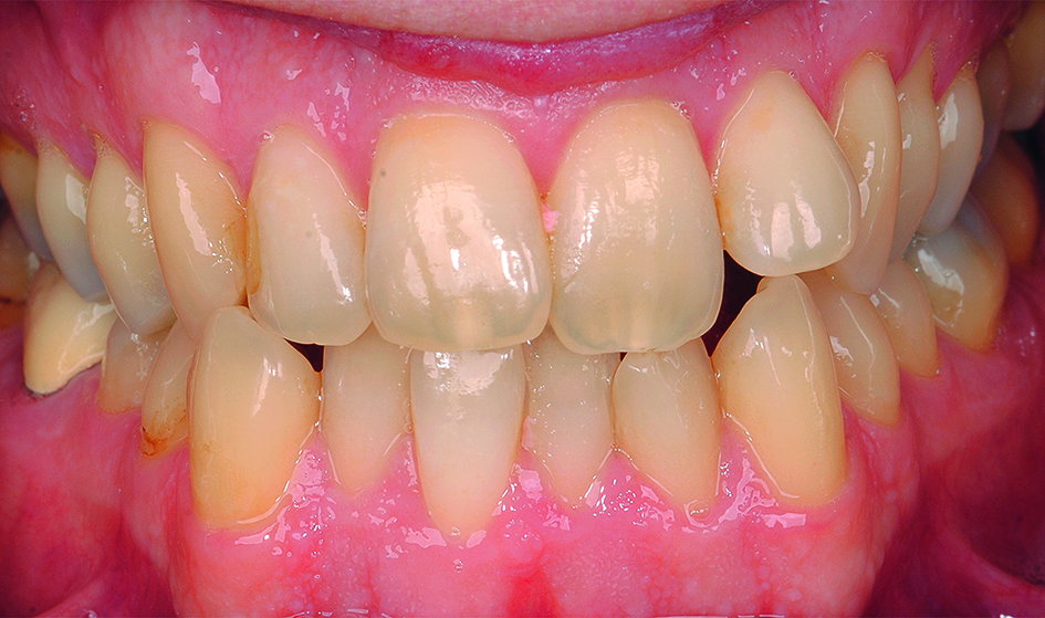 Intraorale opname vóór orthodontische behandeling