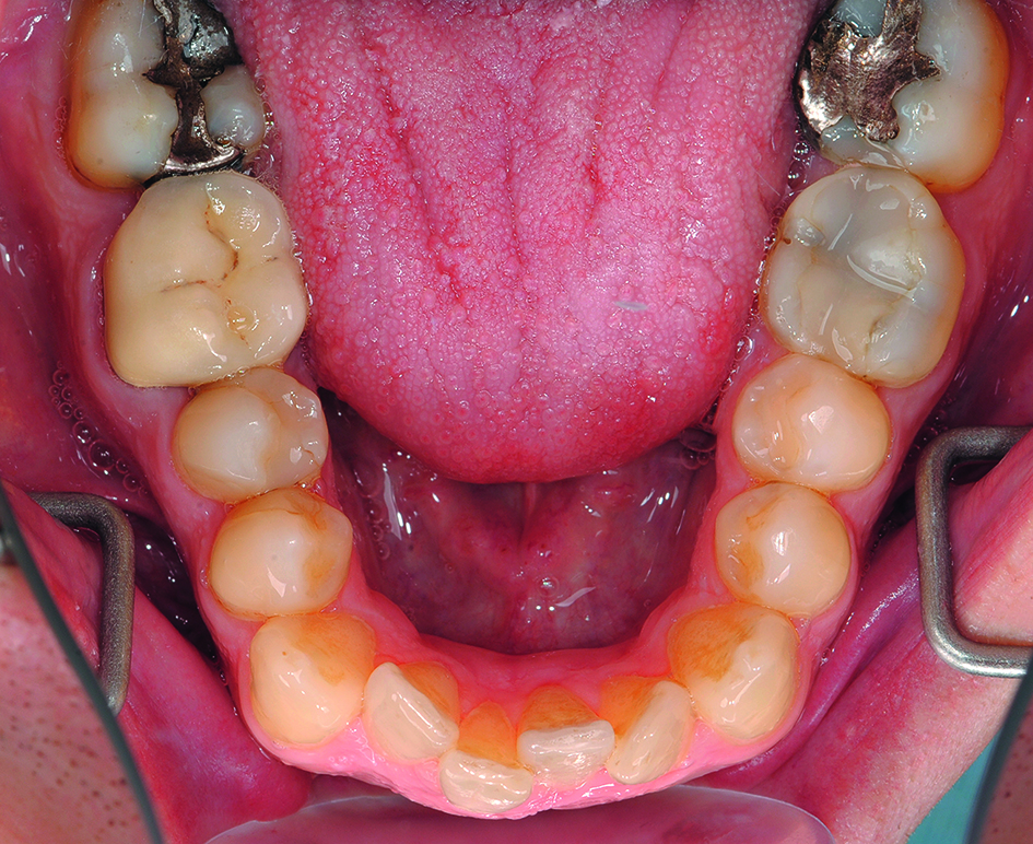 Intraorale opname mandibula vóór orthodontische behandeling