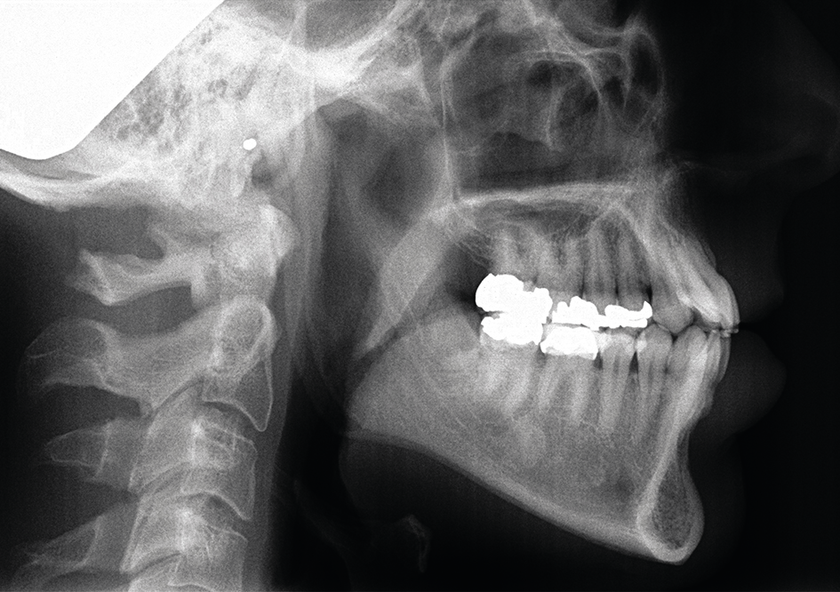 Initiële laterale röntgenschedelprofielopname
