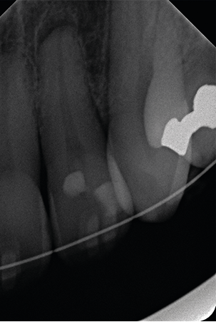 Intraorale röntgenopname gebitselement 21