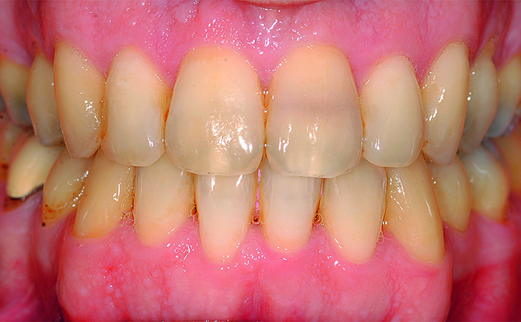 Intraorale opname einde orthodontische behandeling
