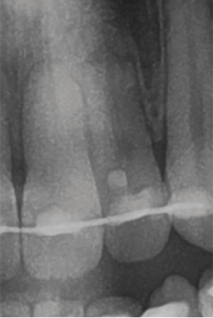 Röntgenopname gebitselement 21 en 22 einde orthodontische behandeling