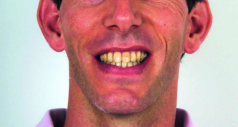 Extraorale opname einde orthodontische behandeling