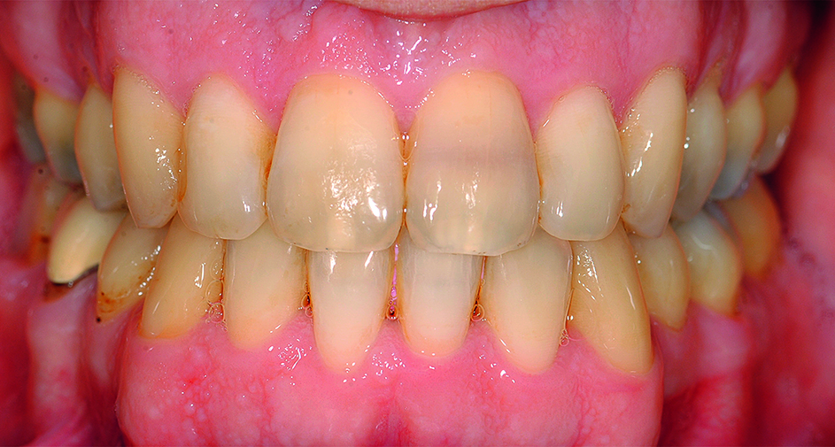 Intraorale opname patiënt einde orthodontische behandeling