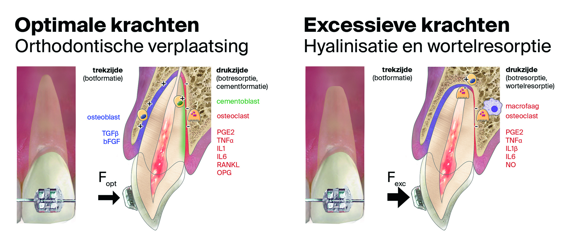 Orthodontische verplaatsing, hyalinisatie en wortelresorptie