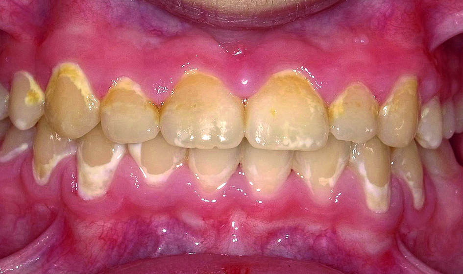 Wittevleklaesies na verwijdering vaste orthodontische apparatuur