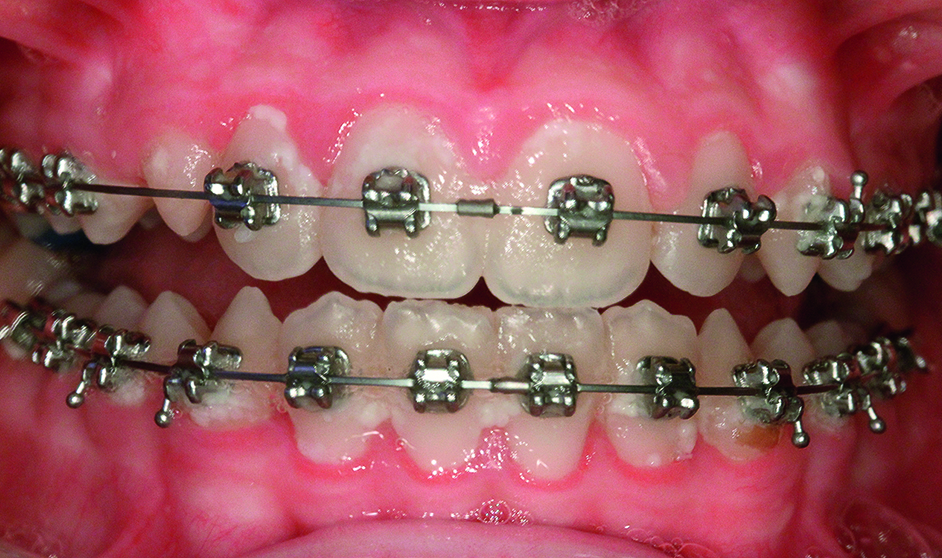 Plaque gingivaal van de bracket