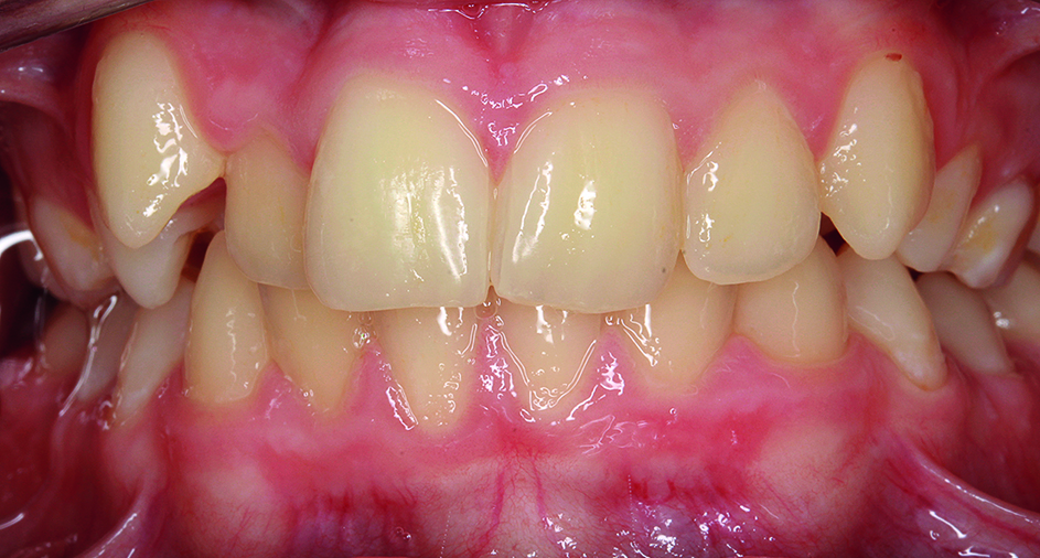 Intraoraal beeld voor de orthodontische behandeling