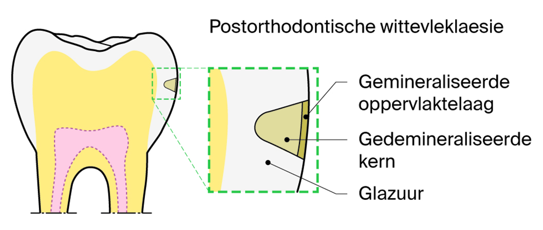 Schematische weergave postorthodontische wittevleklaesie