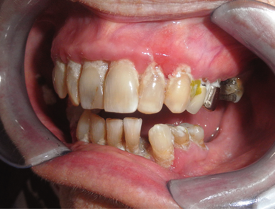 Slechte mondgezondheid en parodontale problematiek