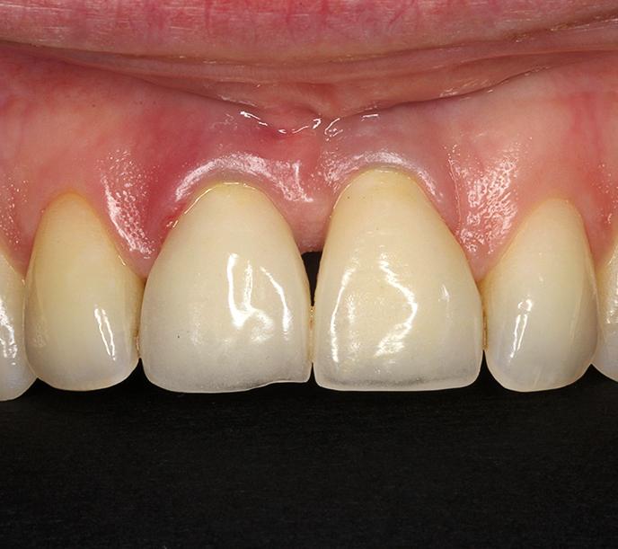 Peri-implantaire mucositis