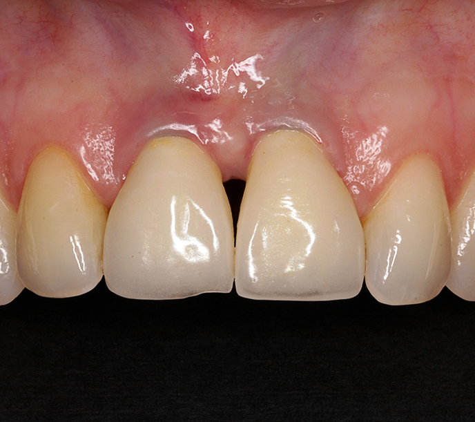 Peri-implantaire mucositis 3 maanden na behandeling