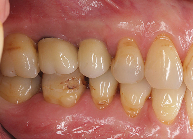 Peri-implantitis met rode mucosa en licht opgezwollen papillen