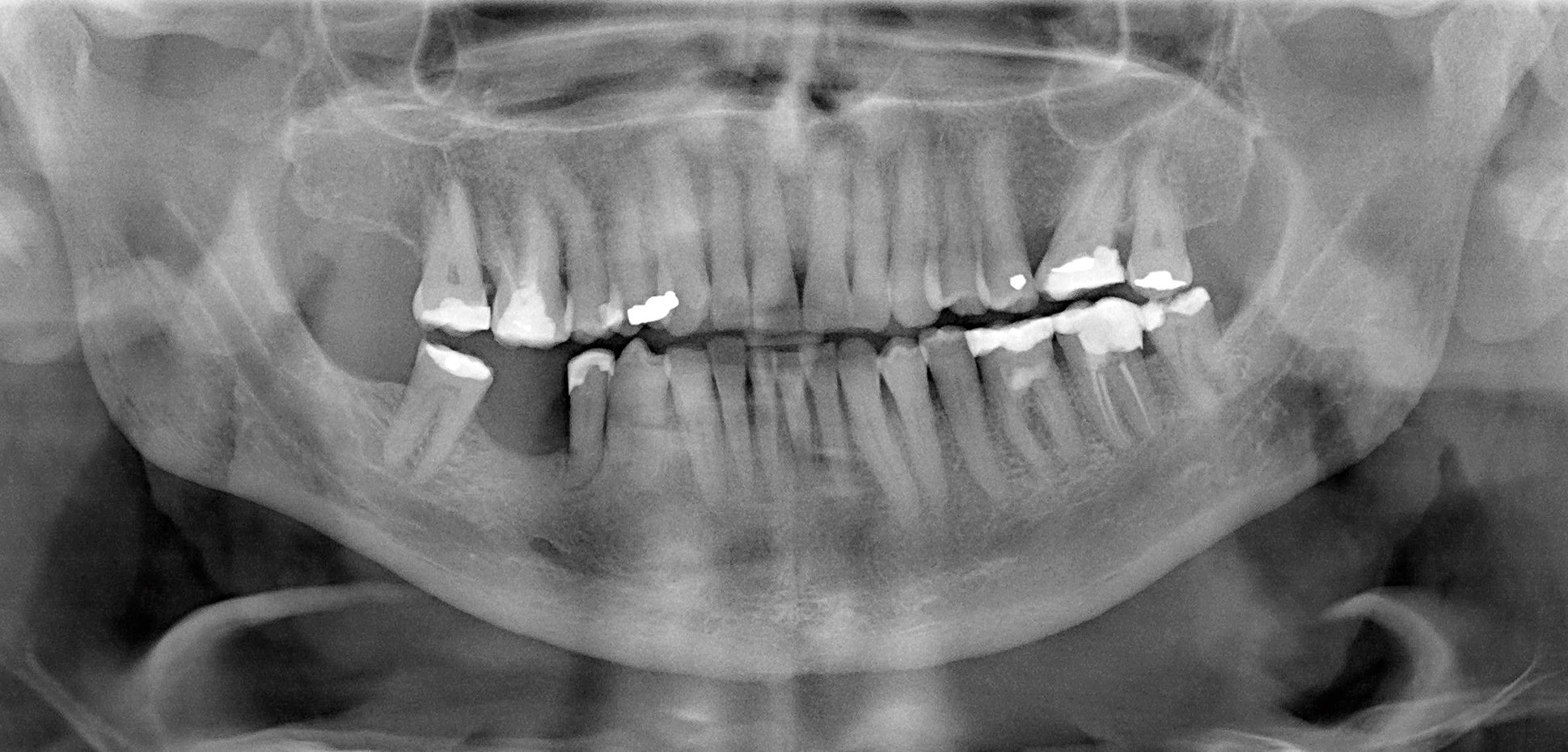 PAN 2 jaar na verwijdering ghost cell-tumor