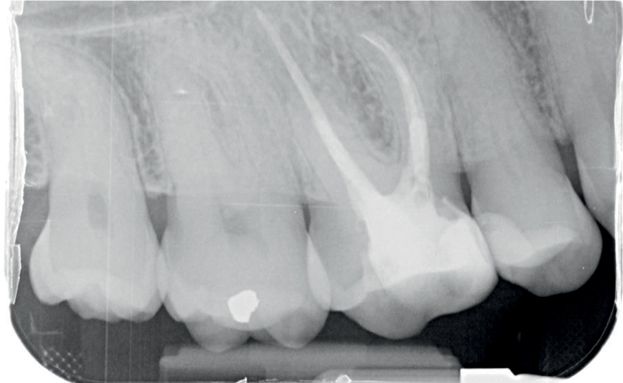 Röntgenopname van de zijdelingse delen na endodontische behandeling